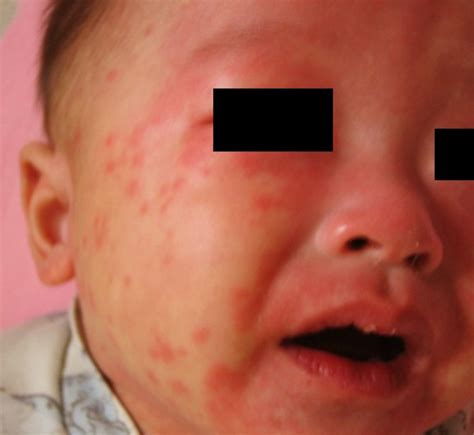 Kawasaki Disease Pictures Symptoms Contagious Causes Treatment