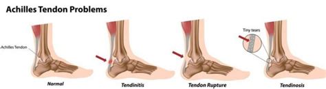 Suffering From Achilles Tendinopathy Put Your Feet In Our