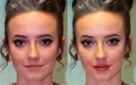 Lip Injections Before And After Photos The Naderi Center For Plastic Surgery Dermatology