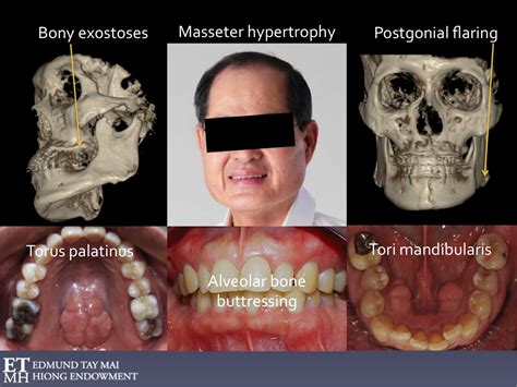 Awake Bruxism Ab And The Masseter Muscle Hypertrophy Controversy
