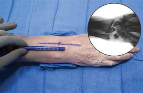 Wrist Intramedullary Nail Implate Skeletal Dynamics