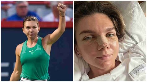 Simona Halep Undergoes Nose Surgery Rendered Unable To Play Until 2023