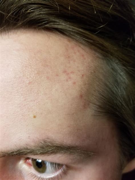 Hive Like Red Marks On The Side Of My Templesforehead Skin Concern