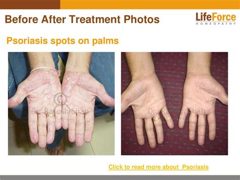 Psoriasis On Hands Photos Before And After Treatment Pictures Of Pat