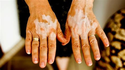 What Does Vitiligo Look Like Causes Symptoms And Treatments