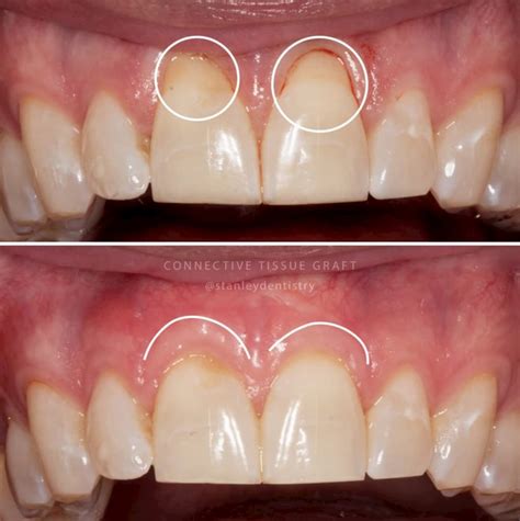 All You Need To Know About Gum Graft Procedure Recovery And Cost