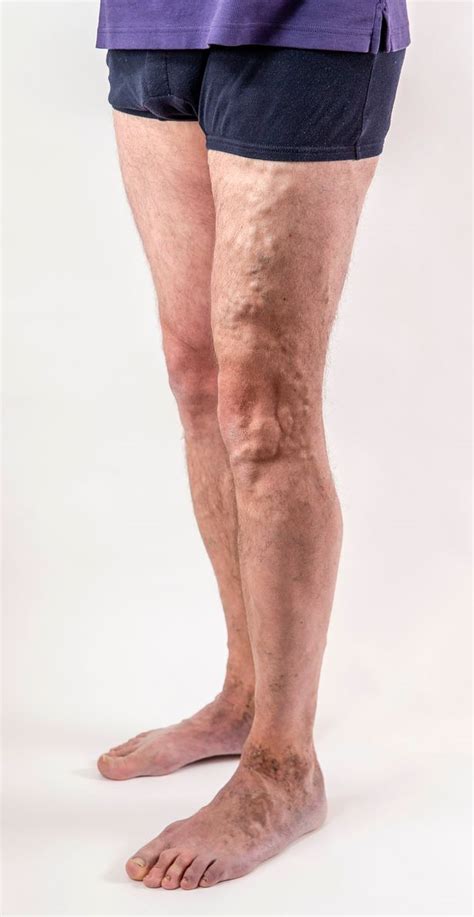 Veins Pains And Ankle Stains How I Ended 30 Years Of Varicose Vein
