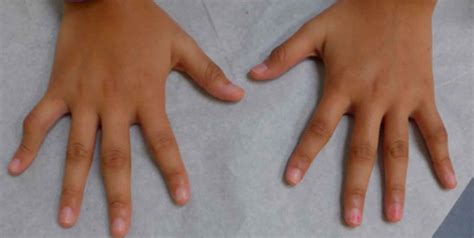 Juvenile Idiopathic Arthritis Causes Symptoms Diagnosis Treatment