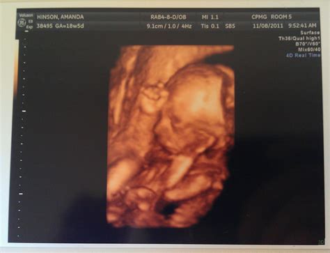 24 weeks pregnant 4d ultrasound managelopers