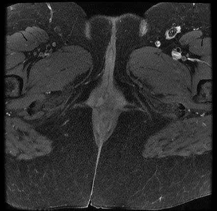 Skene Gland Cyst Mri