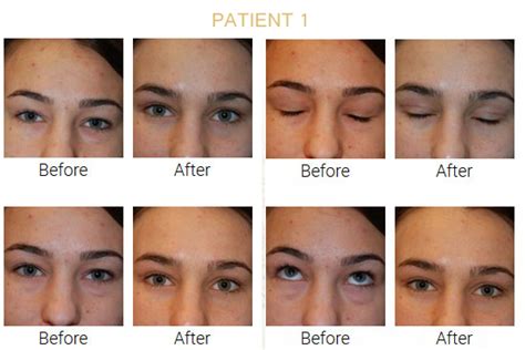 Before After Pictures Of Eyelid Surgery Blepharoplasty Plastic