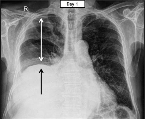 Chest X Ray Showing Oligemic Right Lung Elevated Hemidiaphragm Sexiz Pix