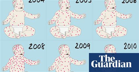 How Measles Outbreaks Have Spread Amid The Anti Vaccine Movement Mmr