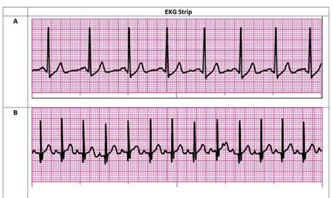 Quizlet Ecg Interpretationmanage Page