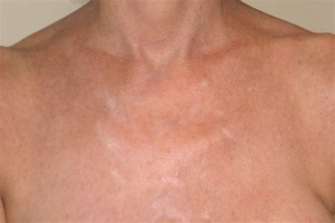 Hypopigmentation On Chest Before And After Needling Amazing Results