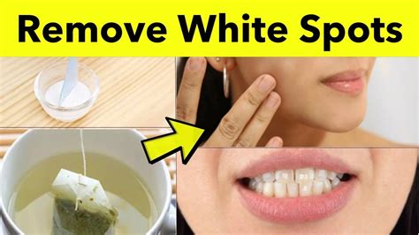 How To Remove White Spots On Skin Natural Remedy For White Patches On Skin Youtube