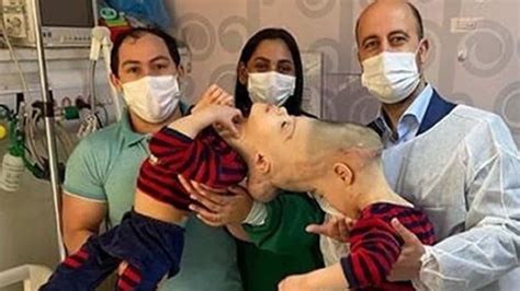 Conjoined Twins With Fused Brain Successfully Separated
