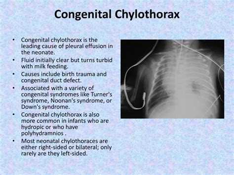 Ppt Chylothorax Pseudochylothorax Powerpoint Presentation Id5875643