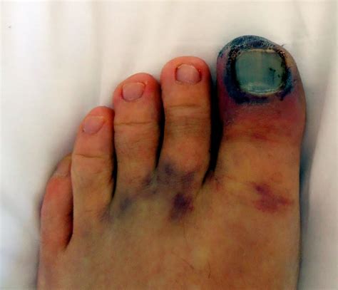 Image Of A 5th Toe Fracture Before