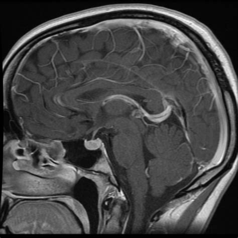 Pituitary Microadenoma Image