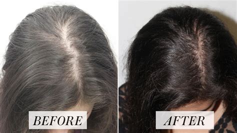 Losing your hair is not usually anything to be worried about, but it can be upsetting. Platelet Rich Plasma Treatment for Hair Loss: Here's What ...