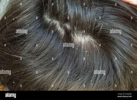 Dandruff In Kid Hair Flaky Scalp Childrens Dandruff Seborrheic