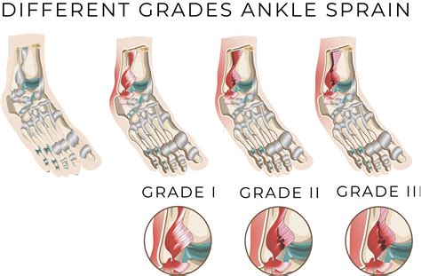 Grade 3 Sprain