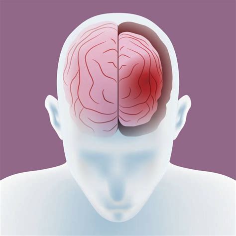 Cerebral Brain Atrophy Why Your Brain Is Shrinking And What To Do