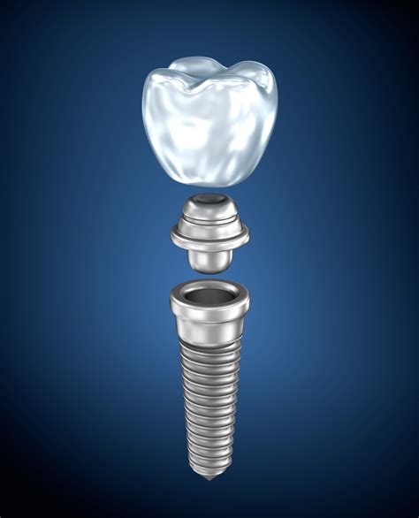 Dental Titanium Implant Weldon Dentistry Blog