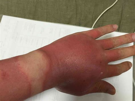 How to treat sunburn pain, according to skin experts