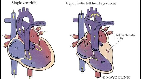 Mayo Clinic Hypoplastic Left Heart Syndrome Youtube