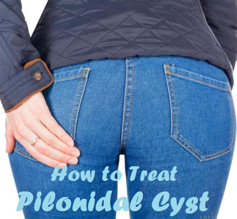 Home Remedies For Pilonidal Cyst Active Home Remedies