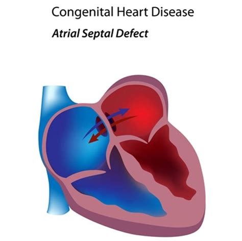Atrial Septal Defect Asd Hole In Heart In Babies And Children