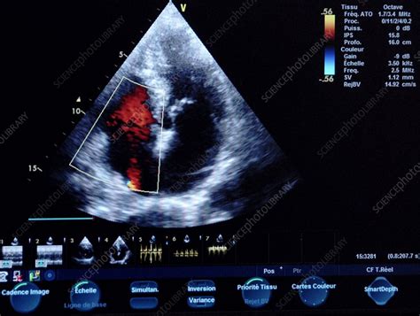 Heart Ultrasound Scan Stock Image C0098334 Science Photo Library