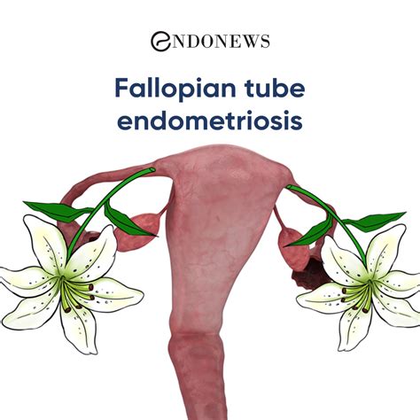 Fallopian Tube Endometriosis Endonews