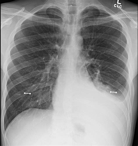 Cureus Spontaneous Resolution Of Recurrent Pleural Effusion In