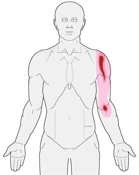 Superficial Strip Of Shoulder Pain When Reaching Up Integrative Works