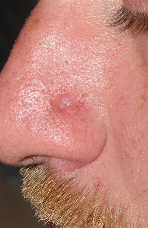 Syphilis On The Face In Primary Care A Rare Sign Of An Increasingly
