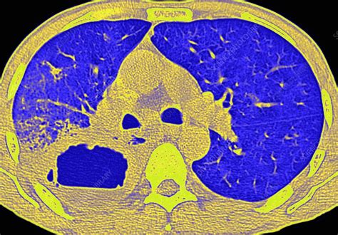 Lung Abscess Ct Scan Stock Image C0187140 Science Photo Library