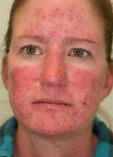 Images of Laser Treatments For Rosacea On Face