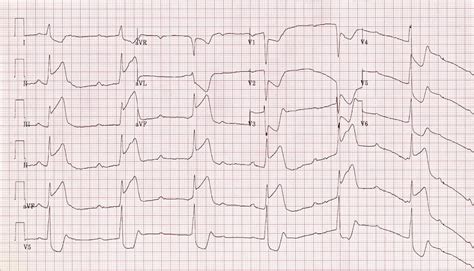 Atria are contracting at own pace. AV block: 3rd degree (complete heart block) • LITFL • ECG ...