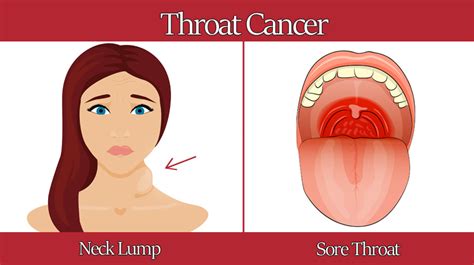 Warning Signs Of Throat Cancer Womenworking
