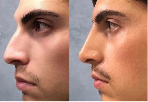 the liquid nose job can you reshape your nose without surgery tasteful space