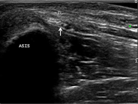 Ultrasound Of The Lateral Femoral Cutaneous Nerve In Asymptomatic