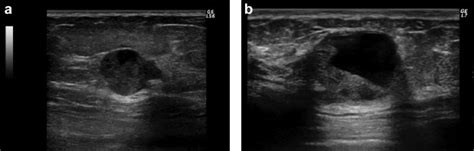 Ultrasound Image Classification Of Ductal Carcinoma In Situ Dcis Of
