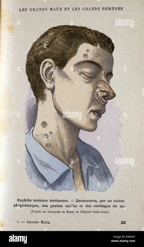 Syphilis Historical Hi Res Stock Photography And Images Alamy