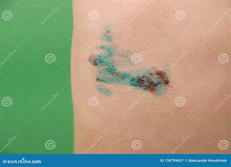 Scraped Knee Of A Little Girl Stock Image Image Of Medicine Body