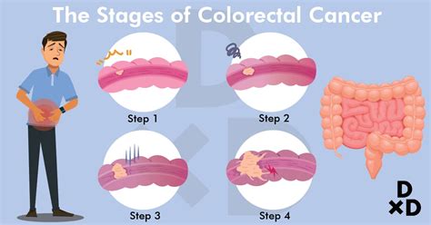 Stages Of Colorectal Cancer