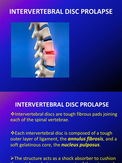 Intervertebral Disc Prolapseppt Diseases And Disorders Clinical