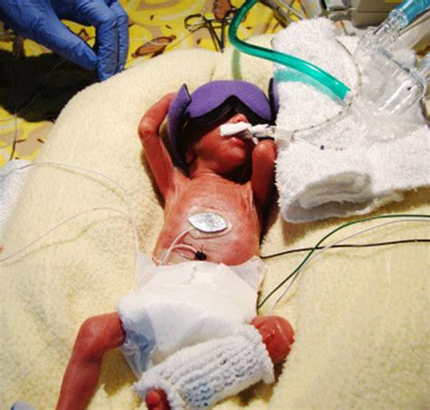Premature Babies May Survive At 22 Weeks If Treated Study